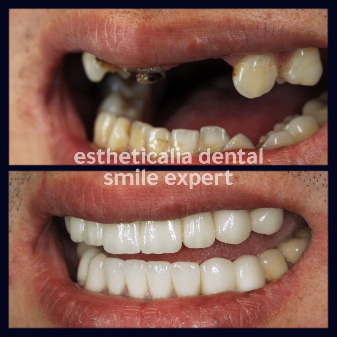 Before & After | Hollywood Smile In Turkey