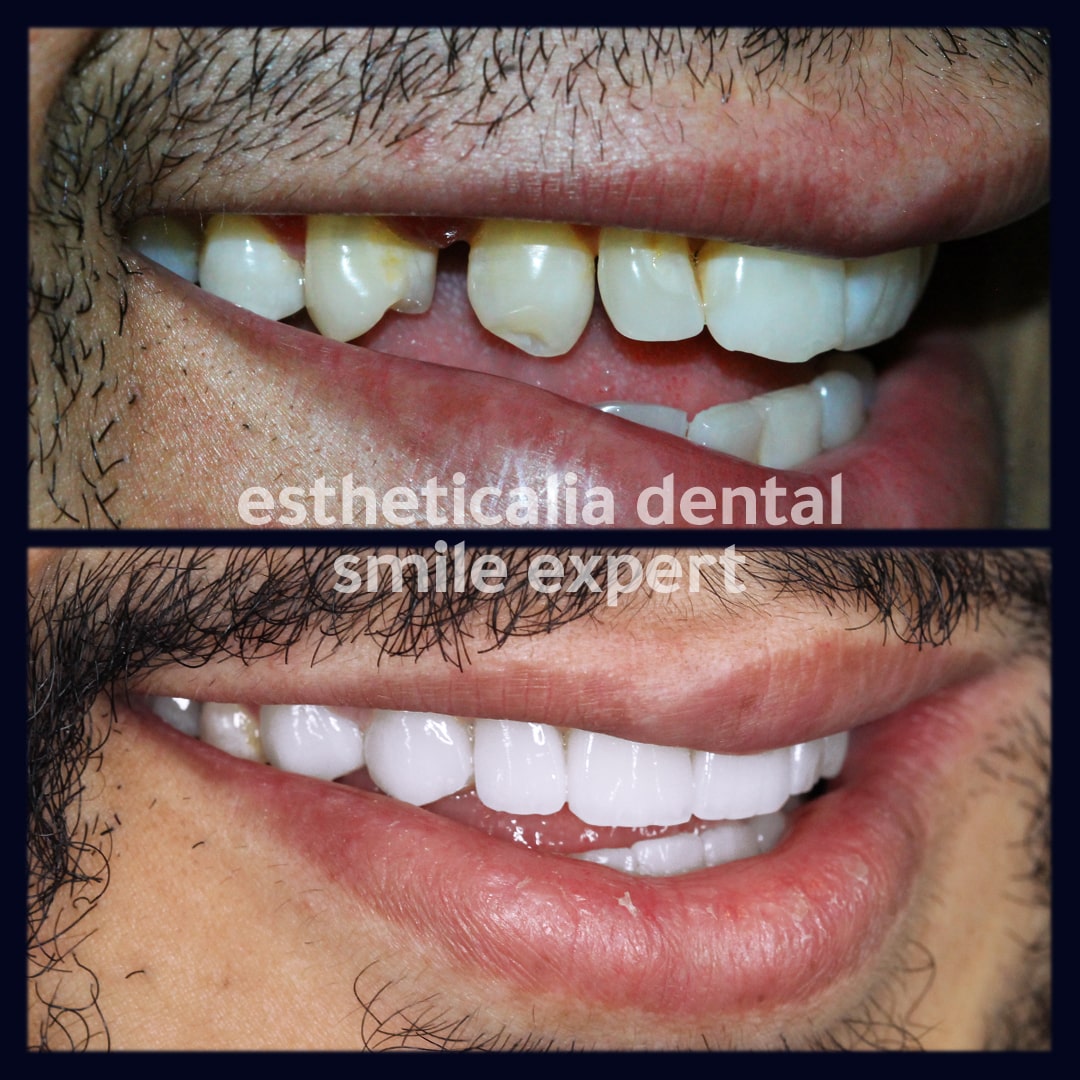 Before & After | Hollywood Smile In Turkey